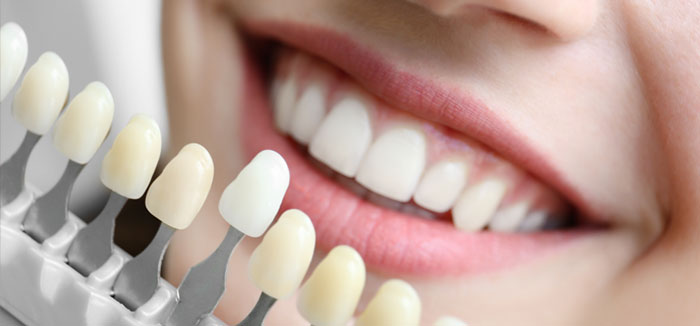 Dental Implants in North Vancouver